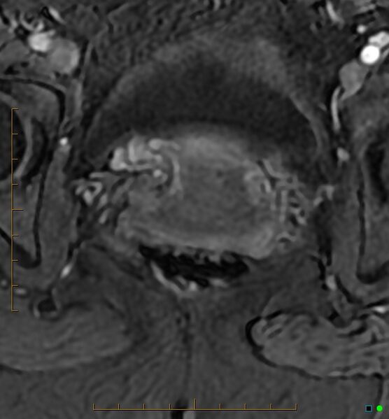 File:Adenomyosis uterus with hematometra (Radiopaedia 45779-50011 Axial T1 C+ fat sat 51).jpg