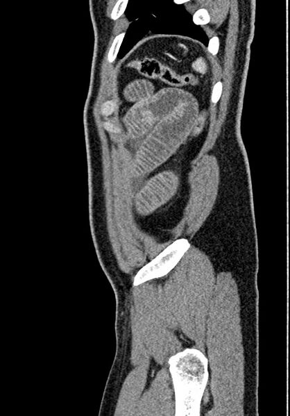 File:Adhesional small bowel obstruction (Radiopaedia 58900-66131 Sagittal C+ portal venous phase 226).jpg
