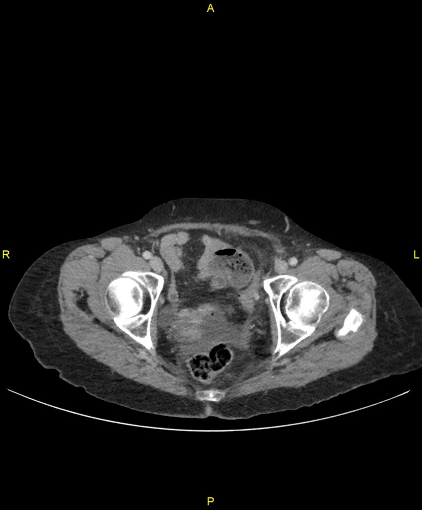 Adhesional small bowel obstruction (Radiopaedia 85402-101024 Axial C+ portal venous phase 266).jpg