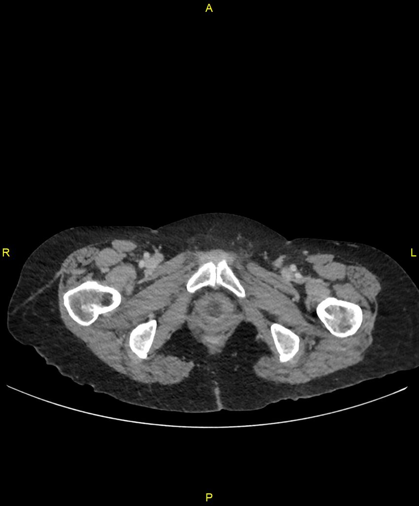 Adhesional small bowel obstruction (Radiopaedia 85402-101024 Axial C+ portal venous phase 297).jpg