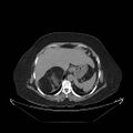 Adrenal myelolipoma (huge) (Radiopaedia 20368).jpg