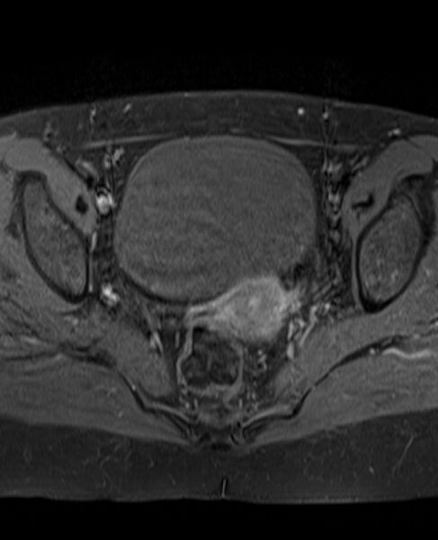 File:Adult granulosa cell tumor of the ovary (Radiopaedia 71581-81950 Axial T1 C+ fat sat 16).jpg