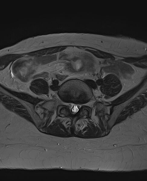 File:Adult granulosa cell tumor of the ovary (Radiopaedia 71581-81950 Axial T2 5).jpg