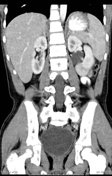 File:Agenesis of the gallbladder (Radiopaedia 55454-61905 A 31).jpg