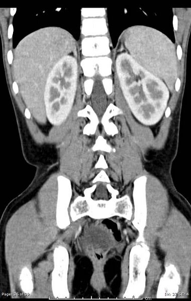 File:Agenesis of the gallbladder (Radiopaedia 55454-61905 A 36).jpg