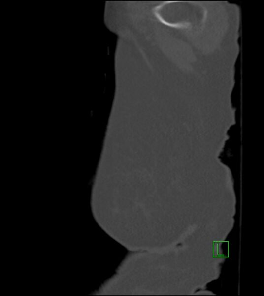 File:Amiodarone deposition in the liver (Radiopaedia 77587-89780 Sagittal bone window 3).jpg