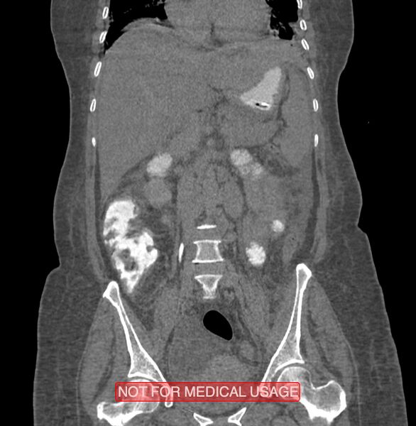 File:Amoebic enterocolitis with liver abscess (Radiopaedia 35100-36609 B 101).jpg
