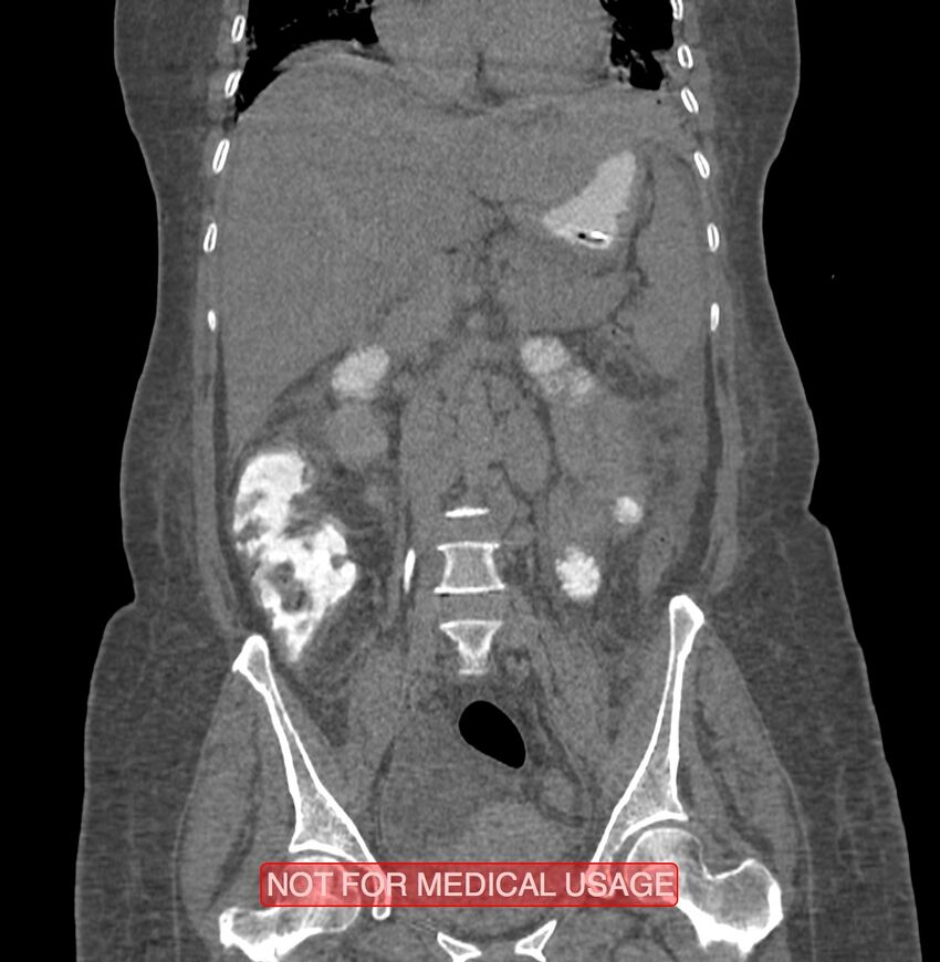 Amoebic enterocolitis with liver abscess (Radiopaedia 35100-36609 B 101).jpg