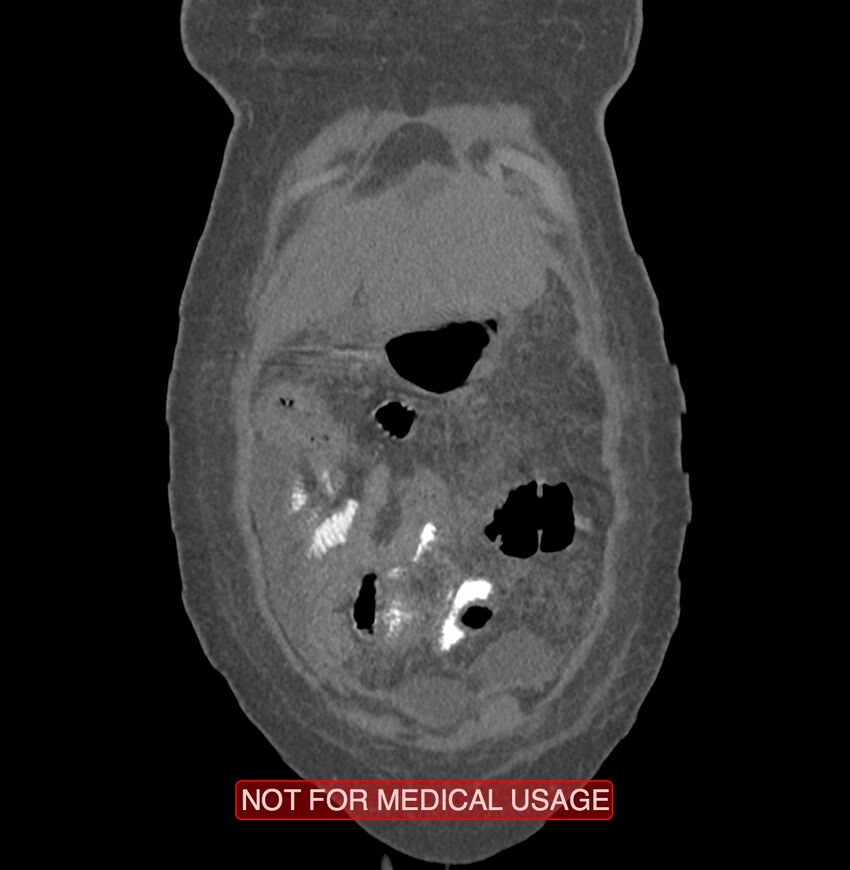 Amoebic enterocolitis with liver abscess (Radiopaedia 35100-36609 B 6).jpg