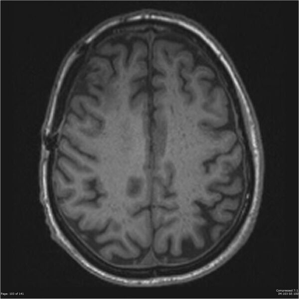 File:Anaplastic meningioma with recurrence (Radiopaedia 34452-35788 Axial T1 101).jpg