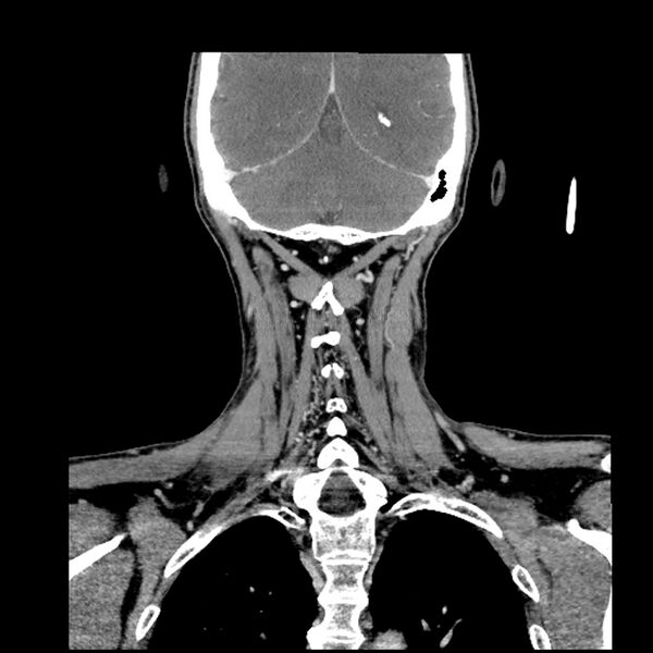 File:Anaplastic thyroid carcinoma (Radiopaedia 79087-92034 A 91).jpg
