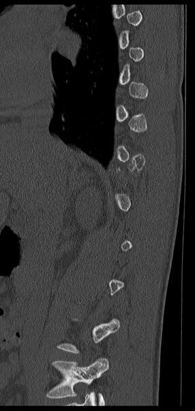 File:Aneurysmal bone cyst T11 (Radiopaedia 29294-29721 Sagittal bone window 56).jpg
