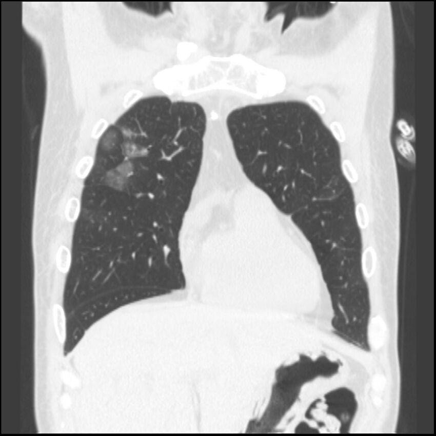 Angioinvasive aspergillosis (Radiopaedia 43957-47466 Coronal lung window 71).jpg