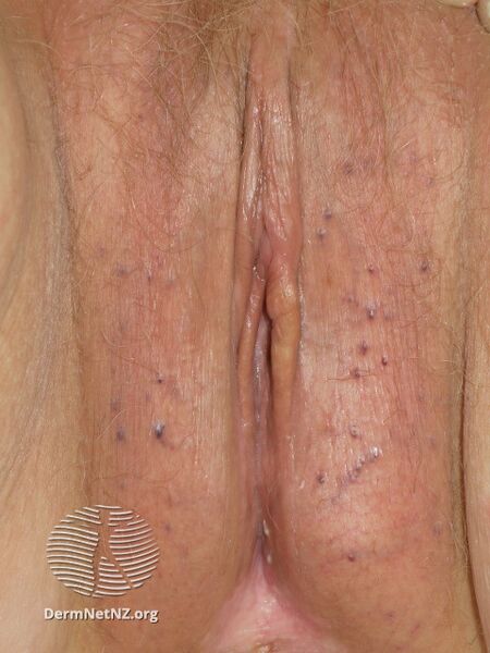 File:Angiokeratoma of Fordyce on vulva (DermNet NZ angiokeratoma-29).jpg