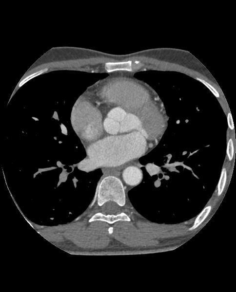 File:Anomalous coronary arteries (Radiopaedia 83979-99206 A 158).jpg