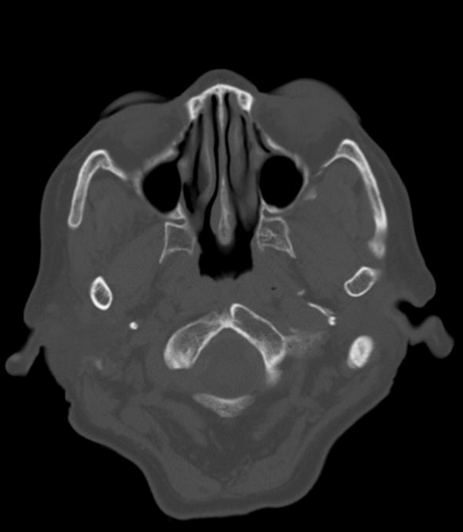 File:Anomalous intracranial venous drainage (Radiopaedia 28161-28418 Axial 18).png