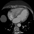 Anomalous origin of left circumflex artery from right coronary sinus (Radiopaedia 72563-83117 B 96).jpg