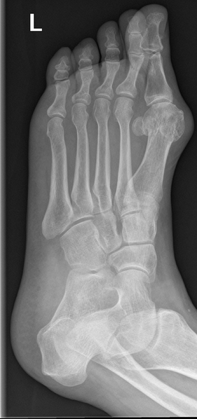 File:Anterior calcaneal process fracture (Radiopaedia 47384-51988 Oblique 1).png