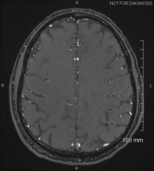 File:Anterior cerebral artery aneurysm (Radiopaedia 80683-94127 Axial MRA 181).jpg