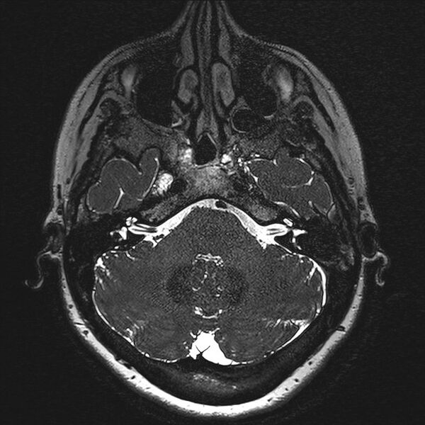 File:Anterior temporal encephalocele (Radiopaedia 82624-96808 Axial T2 high res 14).jpg