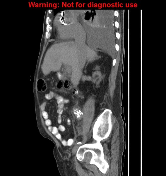 File:Aortic graft infection (Radiopaedia 44979-48907 C 45).jpg