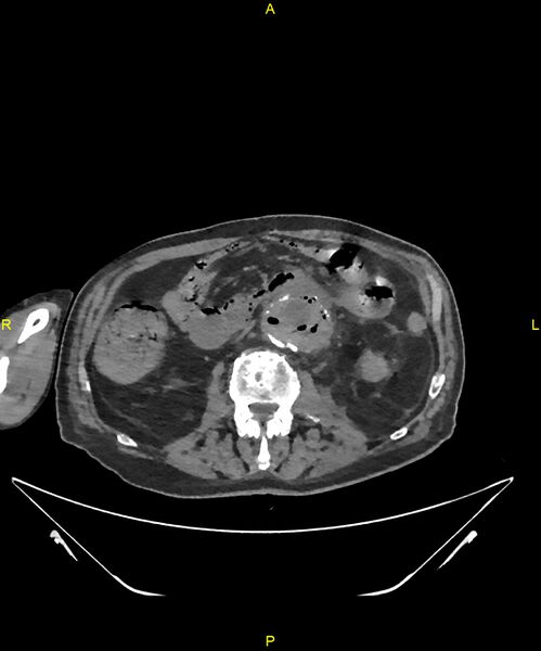 File:Aortoenteric fistula (Radiopaedia 84308-99603 Axial non-contrast 168).jpg