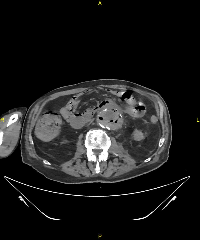 Aortoenteric fistula (Radiopaedia 84308-99603 Axial non-contrast 168).jpg
