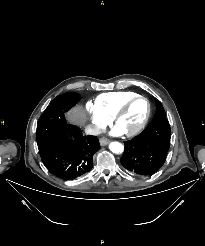 Aortoenteric fistula (Radiopaedia 84308-99603 B 3).jpg