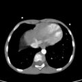 Aortopulmonary window, interrupted aortic arch and large PDA giving the descending aorta (Radiopaedia 35573-37074 B 75).jpg