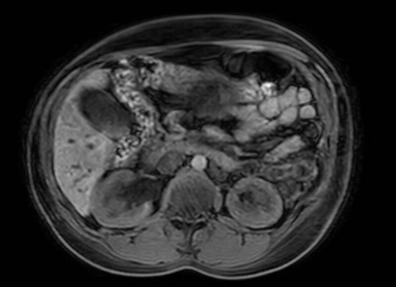 File:Appendicitis in gravida (MRI) (Radiopaedia 89433-106395 Axial DIXON 50).jpg