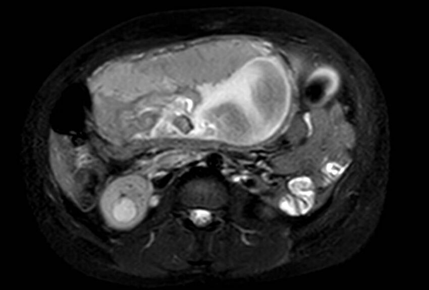 Appendicitis in gravida (MRI) (Radiopaedia 89433-106395 Axial T2 SPAIR 35).jpg