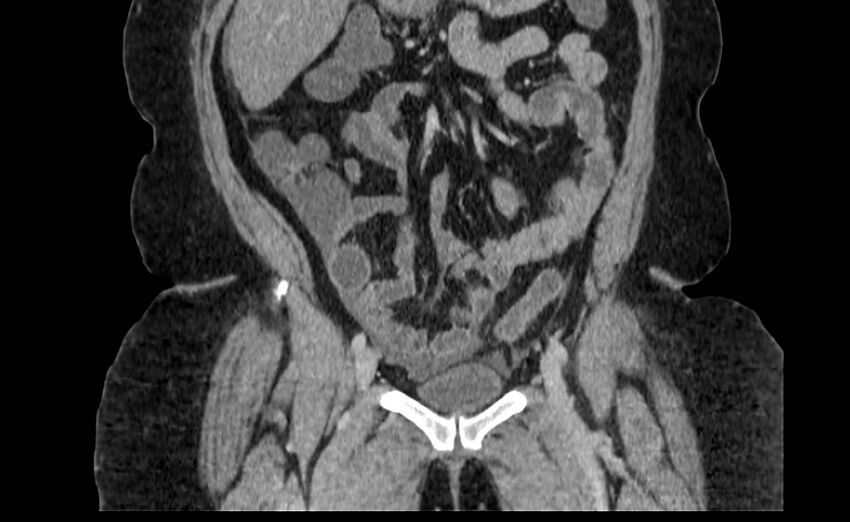 Appendix mucocele (Radiopaedia 41222-44033 B 25).jpg