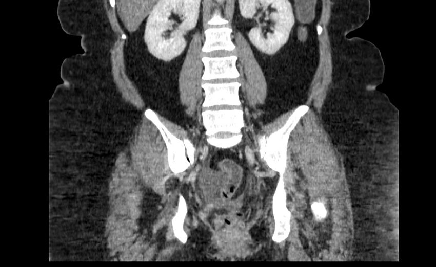 Appendix mucocele (Radiopaedia 41222-44033 B 64).jpg