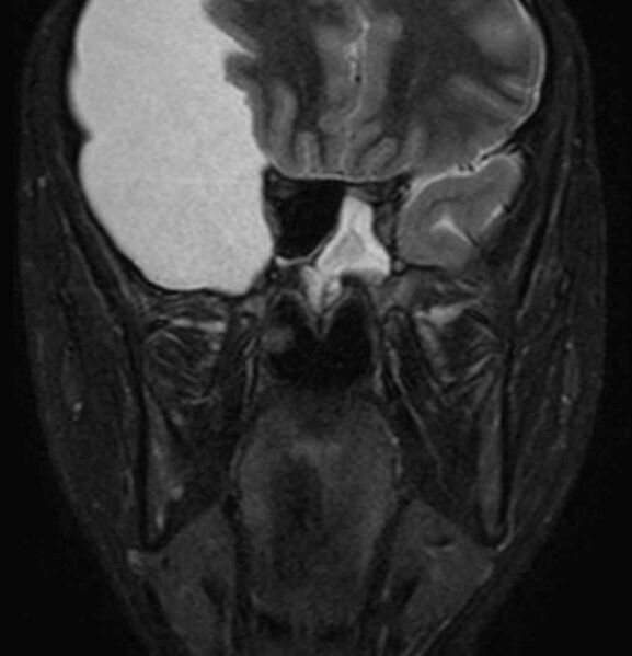File:Arachnoid cyst- extremely large (Radiopaedia 68741-78451 Coronal STIR 17).jpg