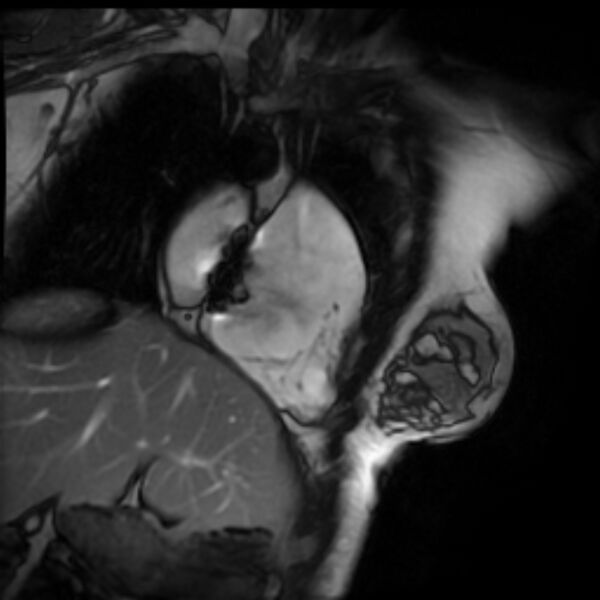 File:Arrhythmogenic right ventricular cardiomyopathy (Radiopaedia 87505-103850 2ch (RV) Cine SSFP 76).jpg