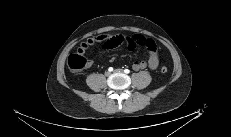 File:Arterial occlusive mesenteric ischemia (Radiopaedia 84641-100060 A 86).jpg