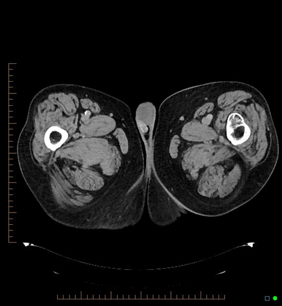 File:Artificial urethral sphincter (Radiopaedia 46937-51464 A 23).jpg