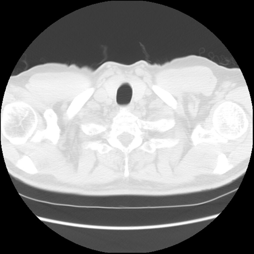 Asbestos-related pleural plaques (Radiopaedia 39069-41255 Axial lung window 2).jpg