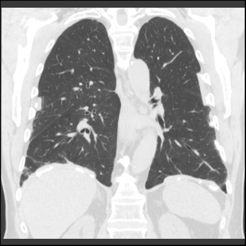 Asbestos-related pleural plaques (Radiopaedia 39069-41255 Coronal lung window 32).jpg