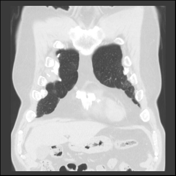 File:Asbestos-related pleural plaques (Radiopaedia 39069-41255 Coronal lung window 75).jpg