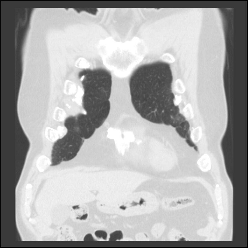 Asbestos-related pleural plaques (Radiopaedia 39069-41255 Coronal lung window 75).jpg
