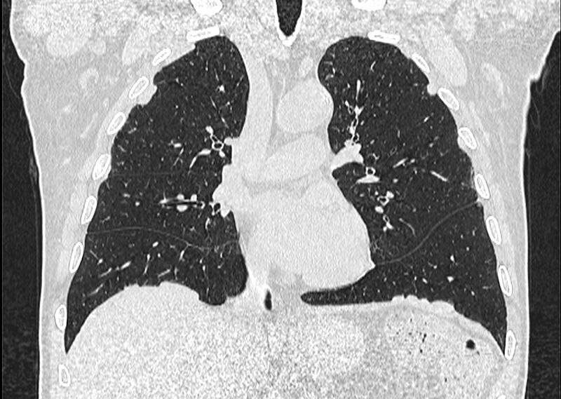 File:Asbestos pleural placques (Radiopaedia 57905-64872 Coronal lung window 128).jpg