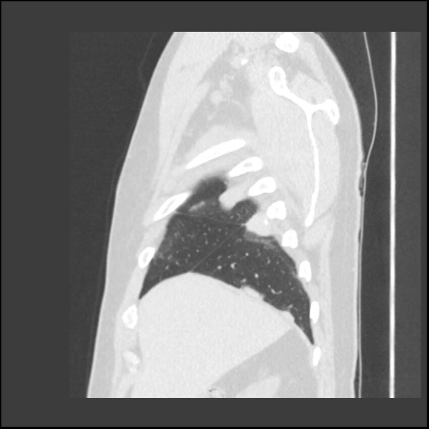 Asbestosis (Radiopaedia 45002-48961 Sagittal lung window 120).jpg