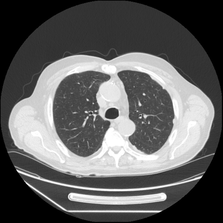 Asbestosis complicated by lung cancer (Radiopaedia 45834-50116 Axial lung window 23).jpg