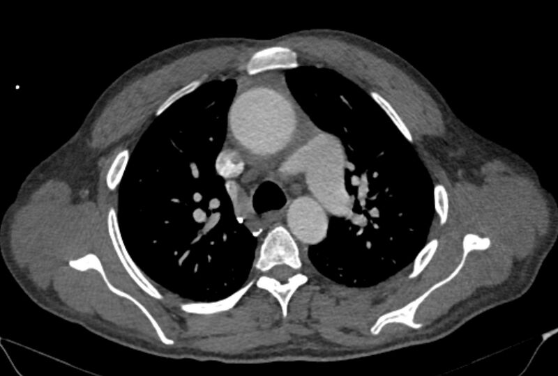 File:Ascending aortic aneurysm (Radiopaedia 86279-102297 C 18).jpg