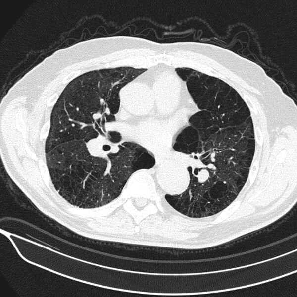 File:Aspergilloma (Radiopaedia 24521-24804 Axial lung window 12).jpg