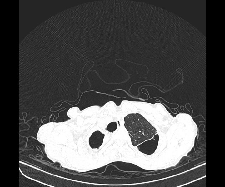 File:Aspergillomas (Radiopaedia 66779-76110 Axial lung window 13).jpg