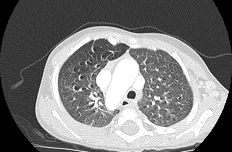 File:Asplenia syndrome (Radiopaedia 73083-83792 Axial lung window 19).jpg