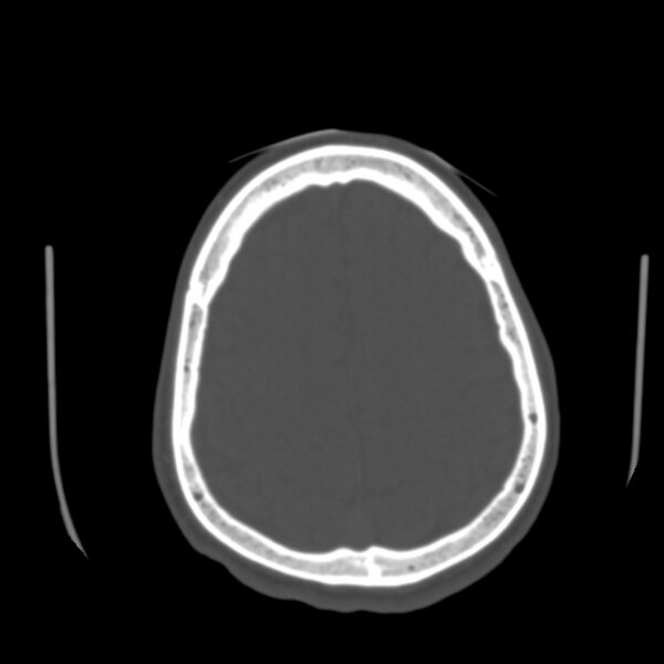 File:Asymptomatic occipital spur (Radiopaedia 87753-104201 Axial bone window 168).jpg