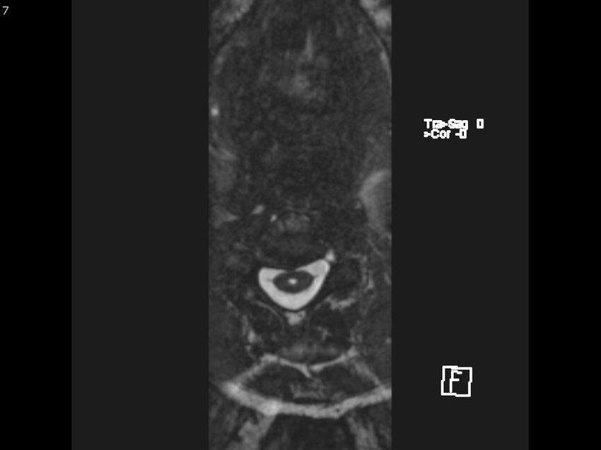 Atypical meningioma - intraosseous (Radiopaedia 64915-74572 Axial CISS 7).jpg